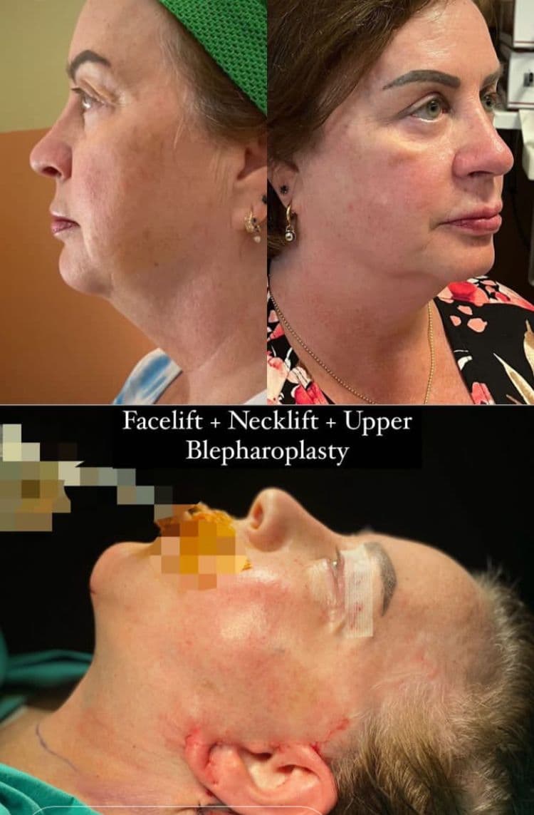 Resultados Lifting Facial de Plano Profundo - Caso 2
