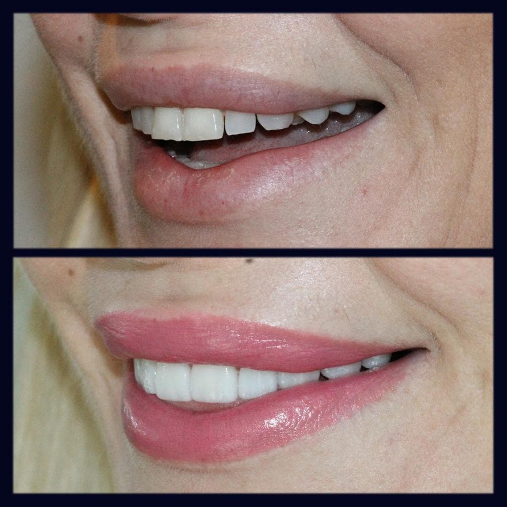 Rezultate Implanturi Dentare Premium - Cazul 6