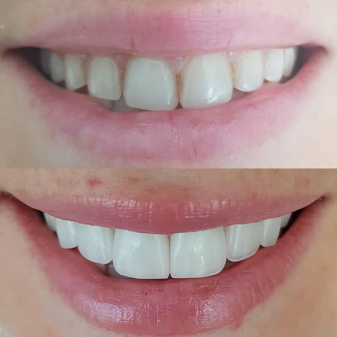 Rezultate Implanturi Dentare Premium - Cazul 7