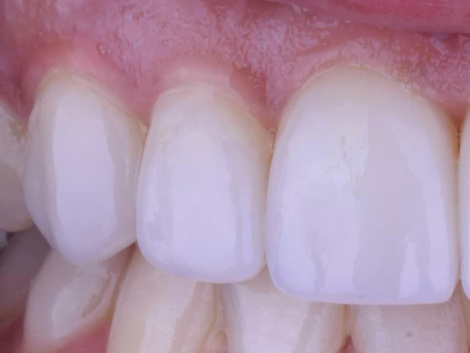 Rezultate Implanturi Dentare Premium - Cazul 8