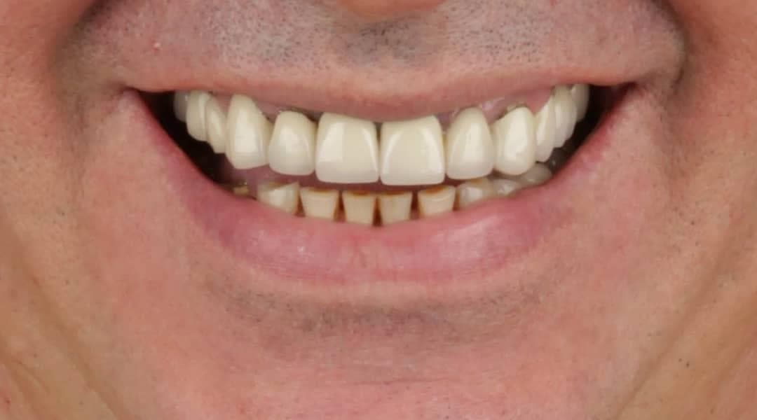 Rezultate Implanturi Dentare Premium - Cazul 20