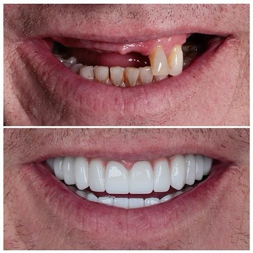 Rezultate Implanturi Dentare Premium - Cazul 22