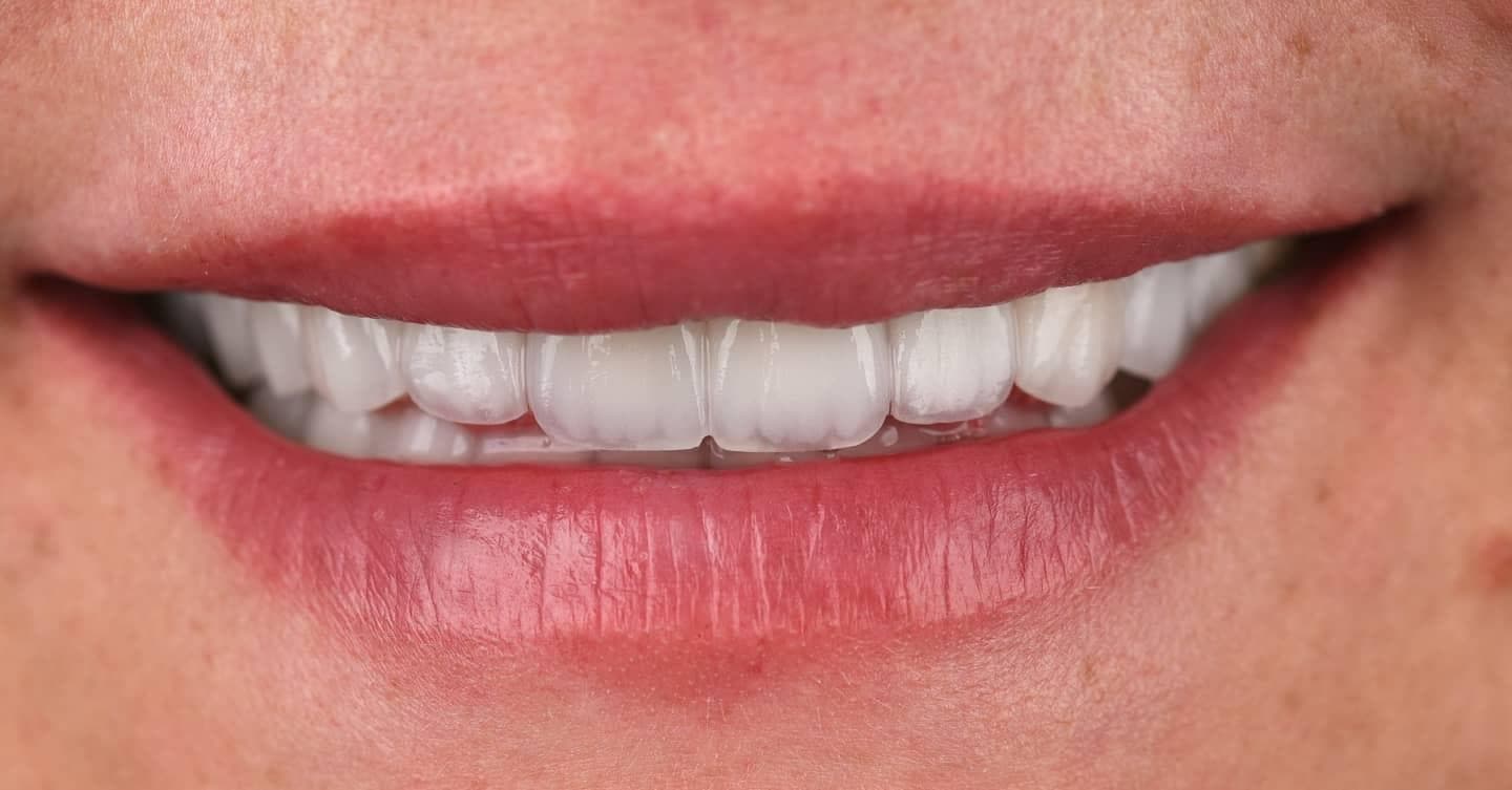 Rezultate Implanturi Dentare Premium - Cazul 24