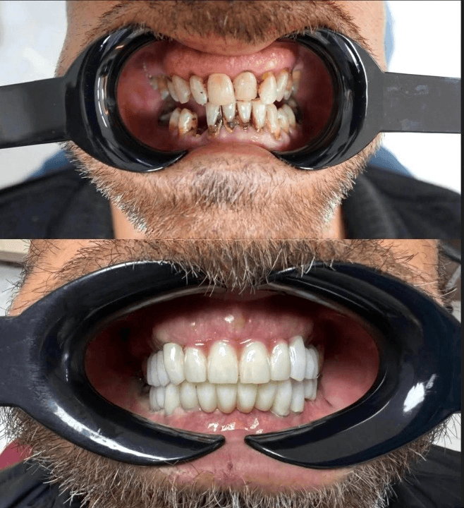 Rezultate Implanturi Dentare Premium - Cazul 26