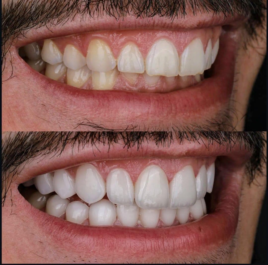 Rezultate Implanturi Dentare Premium - Cazul 27