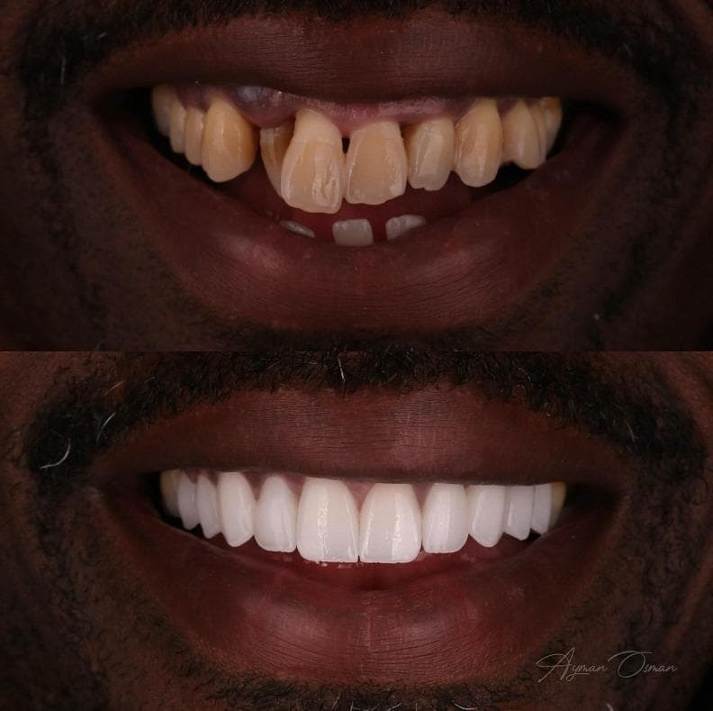 Rezultate Implanturi Dentare Premium - Cazul 28