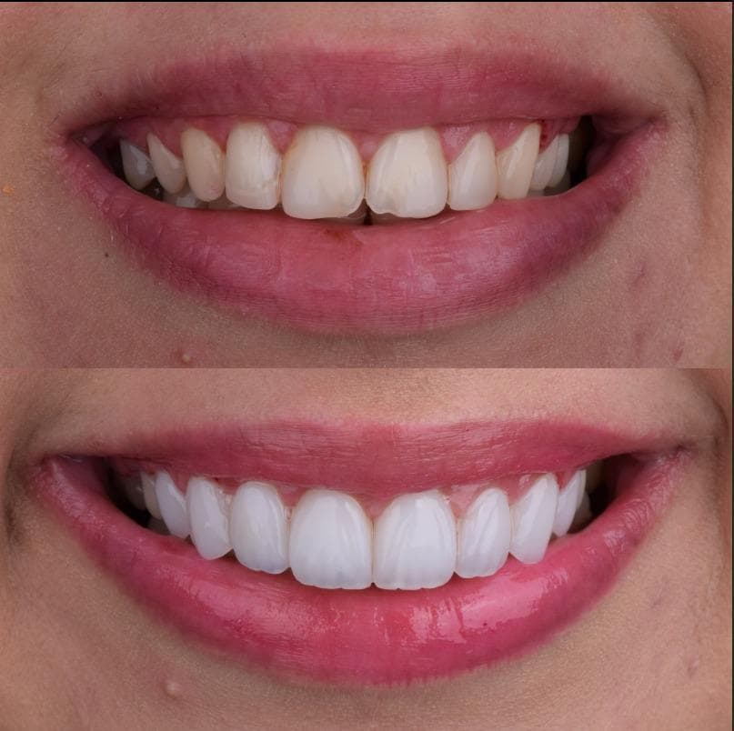 Rezultate Implanturi Dentare Premium - Cazul 31