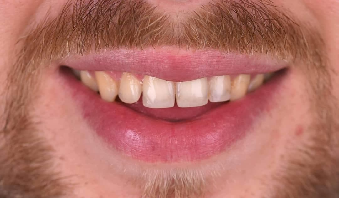 Rezultate Implanturi Dentare Premium - Cazul 34
