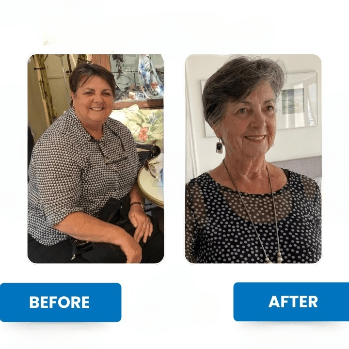 Risultati Sleeve Gastrectomy - Caso 3