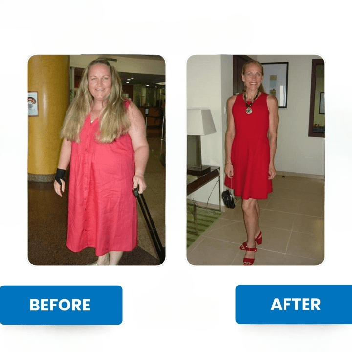 Risultati Sleeve Gastrectomy - Caso 9