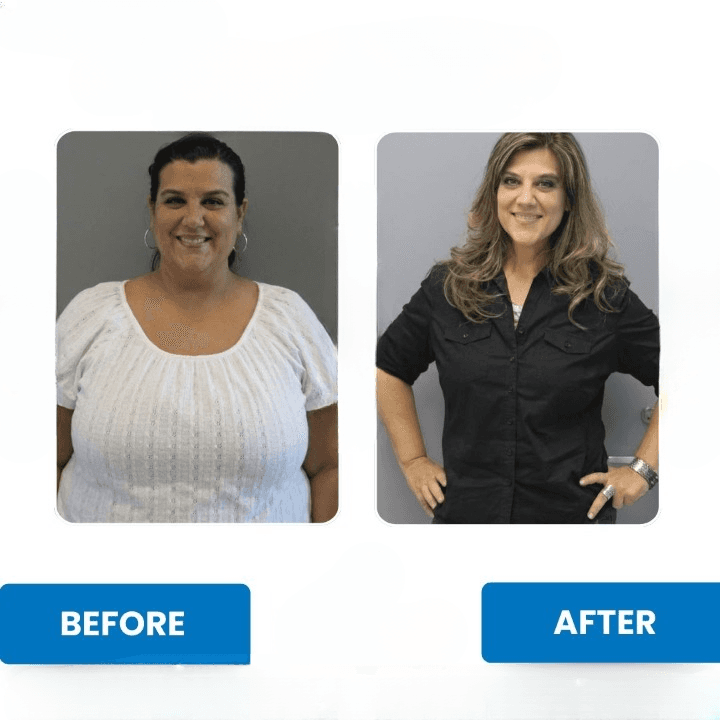 Risultati Sleeve Gastrectomy - Caso 11