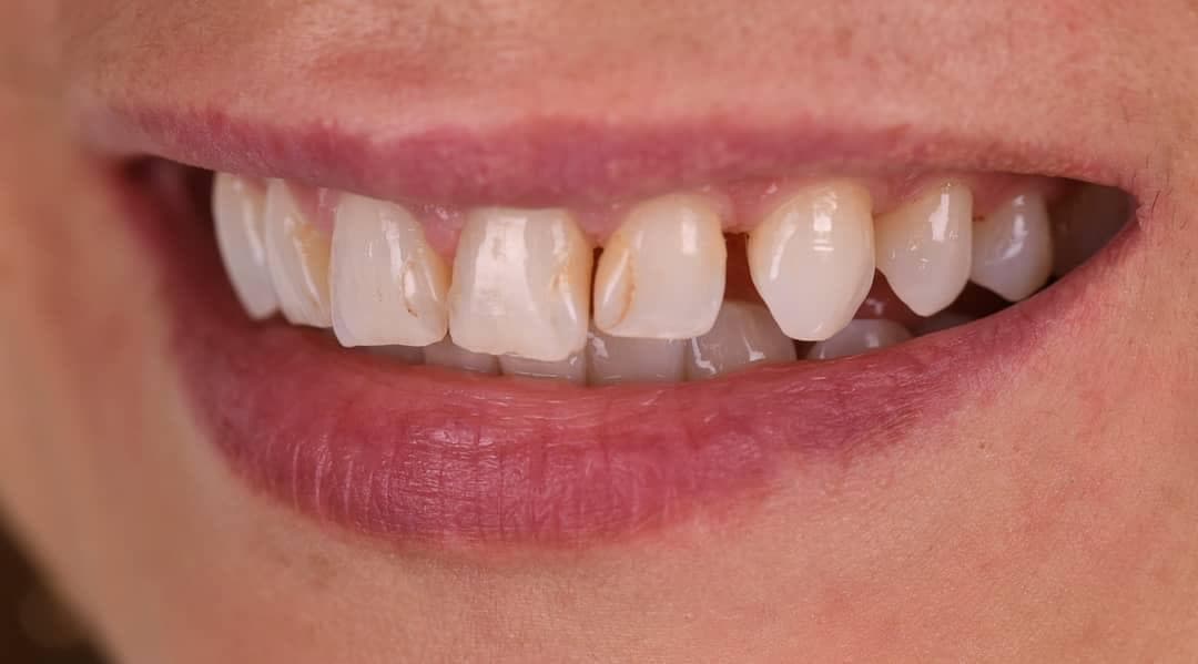 Resultados Diseño de Sonrisa de Hollywood - Caso 1