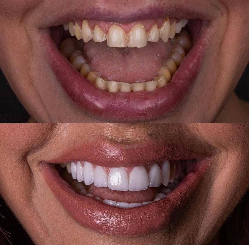 Resultados Diseño de Sonrisa de Hollywood - Caso 2