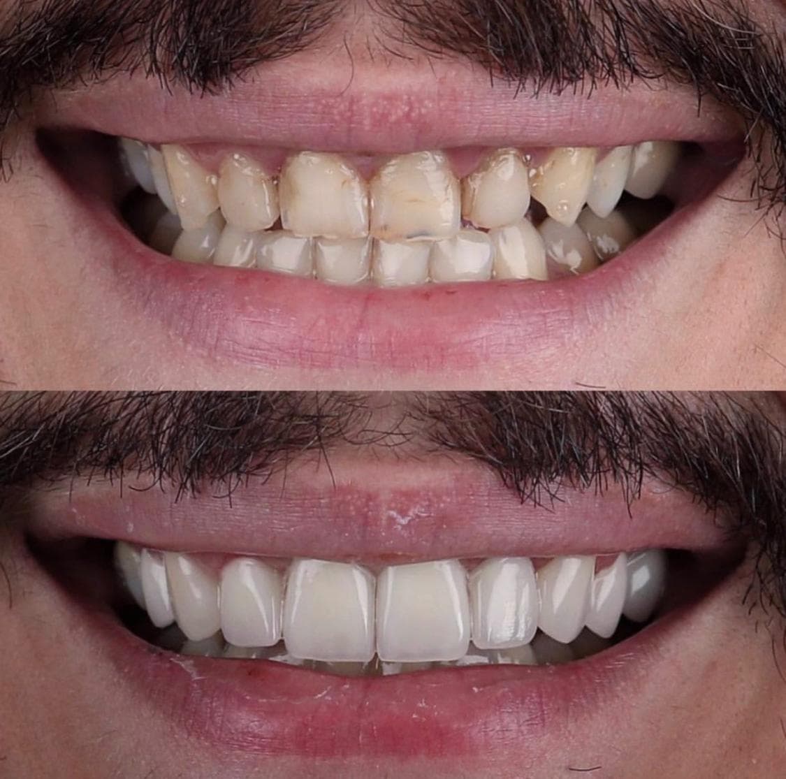 Resultados Diseño de Sonrisa de Hollywood - Caso 3