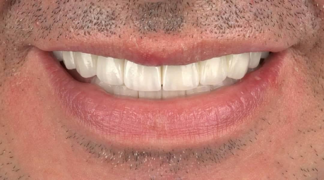 Resultados Diseño de Sonrisa de Hollywood - Caso 4