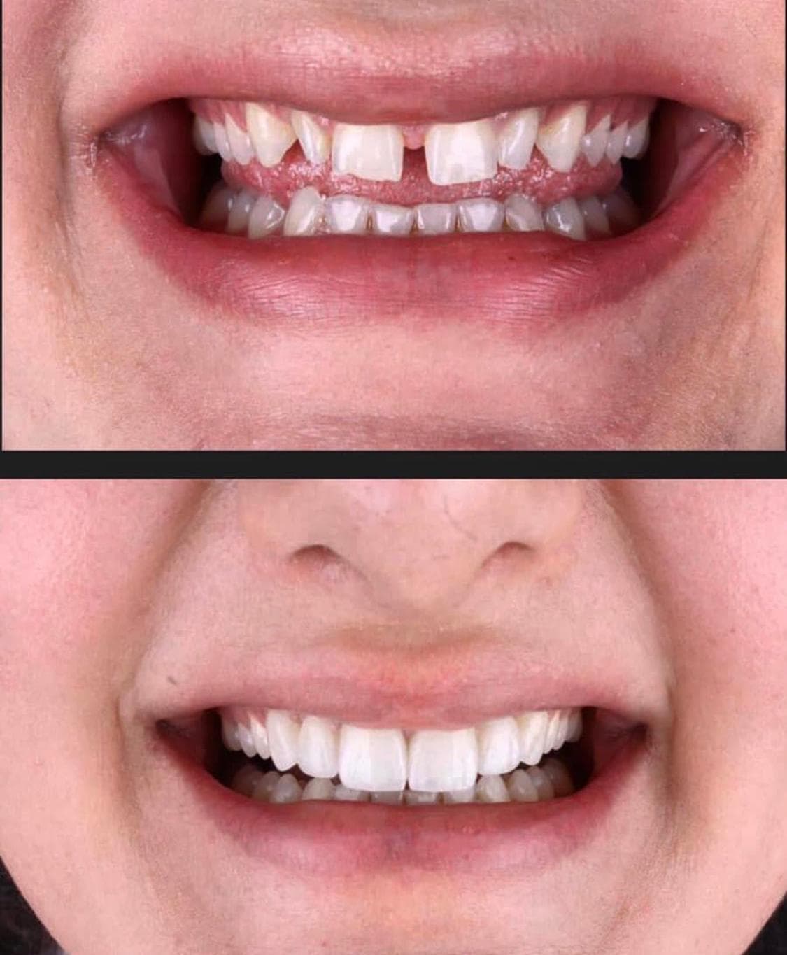 Resultados Diseño de Sonrisa de Hollywood - Caso 9