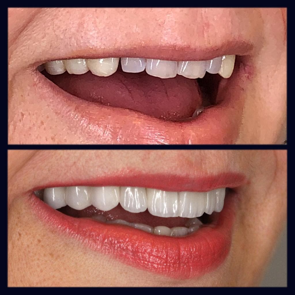 Resultados Diseño de Sonrisa de Hollywood - Caso 10
