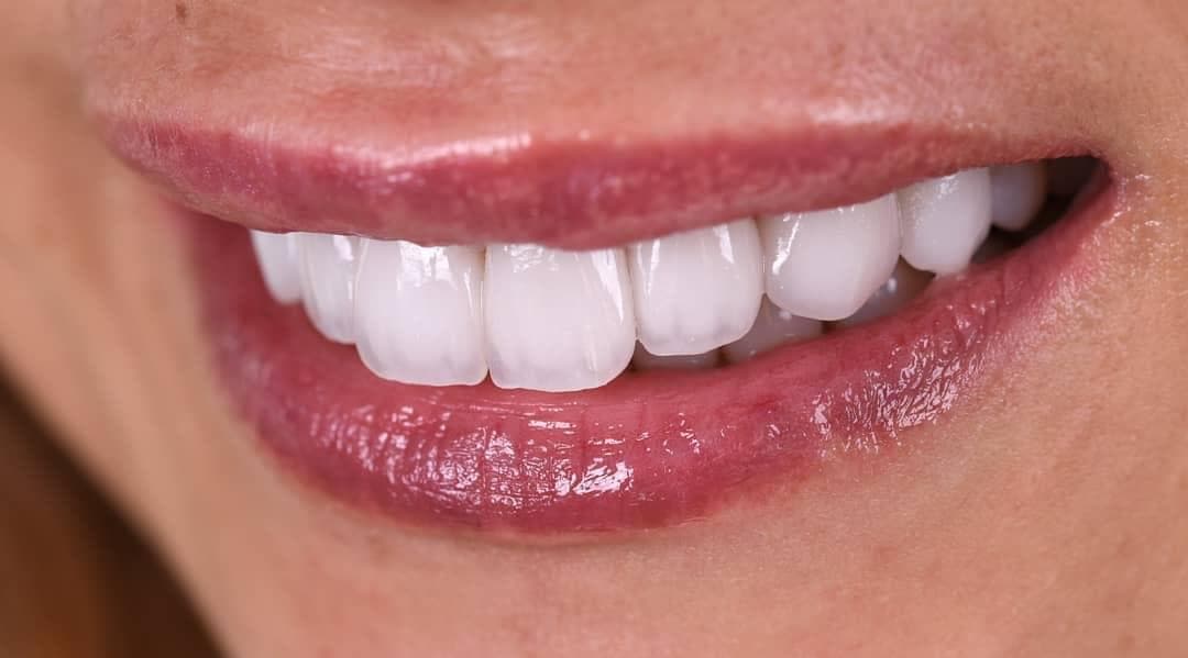 Resultados Diseño de Sonrisa de Hollywood - Caso 11