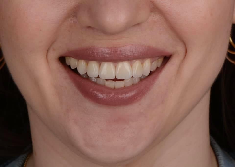 Resultados Diseño de Sonrisa de Hollywood - Caso 13