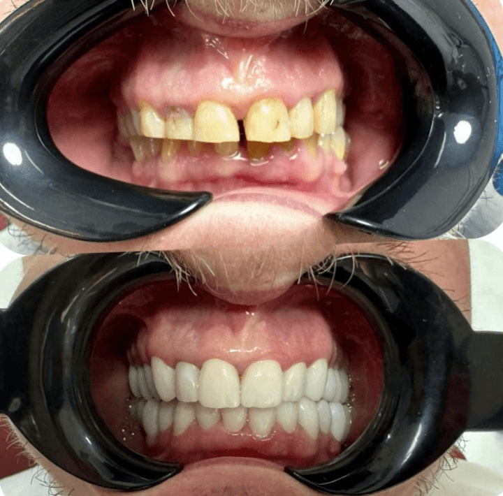 Resultados Diseño de Sonrisa de Hollywood - Caso 29