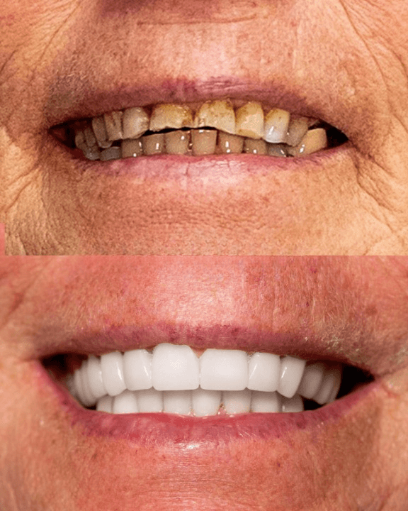 Resultados Diseño de Sonrisa de Hollywood - Caso 30