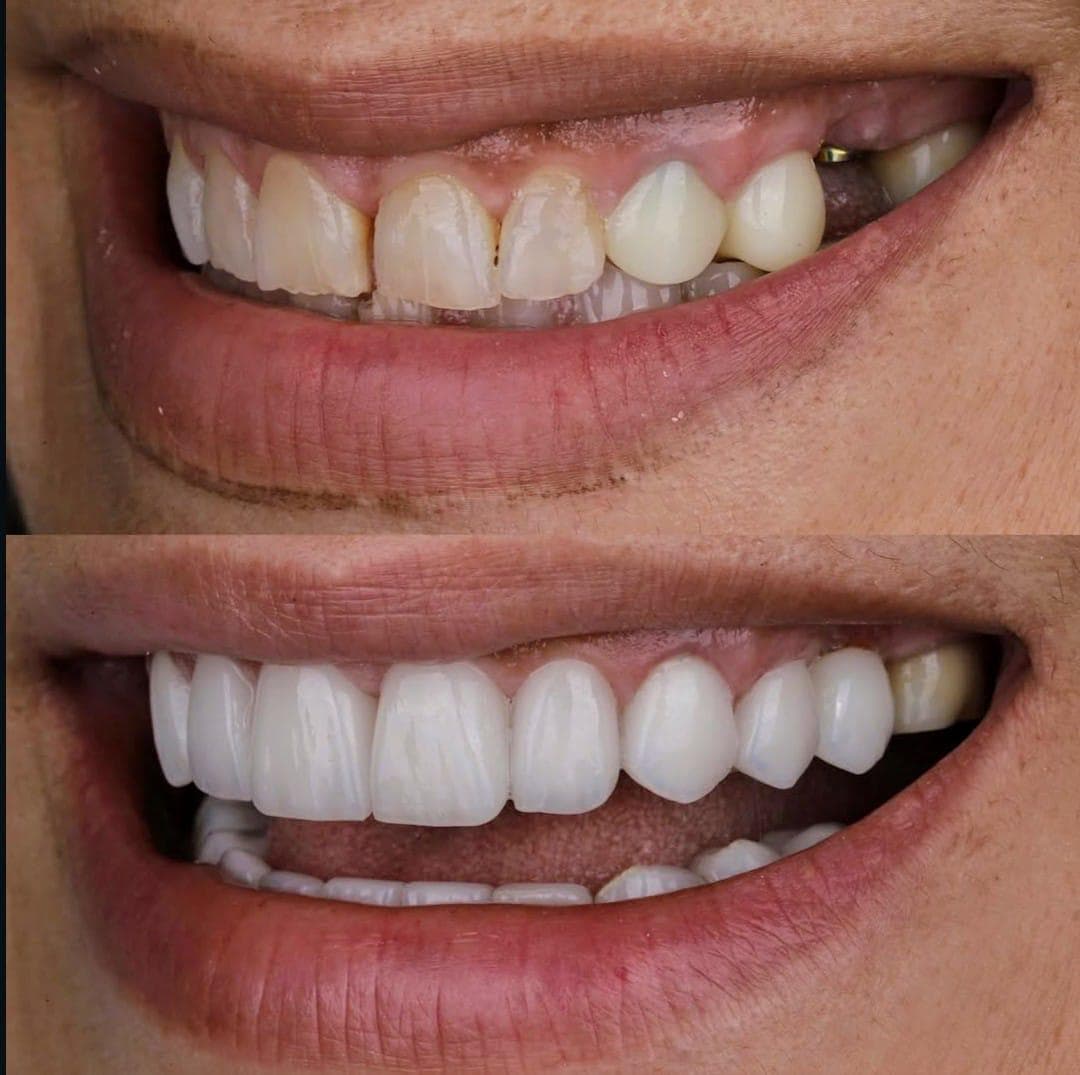 Resultados Diseño de Sonrisa de Hollywood - Caso 32