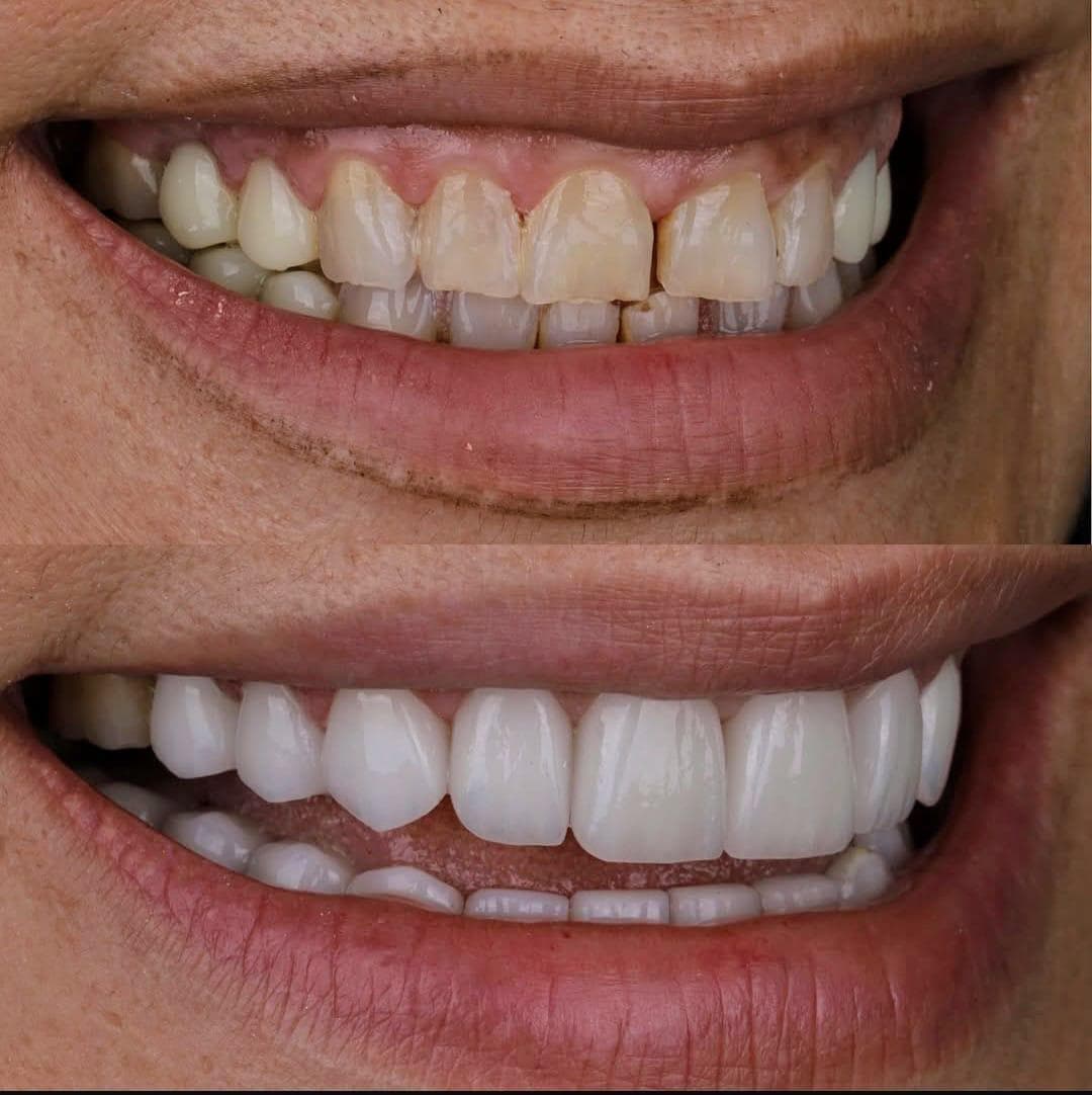 Resultados Diseño de Sonrisa de Hollywood - Caso 33