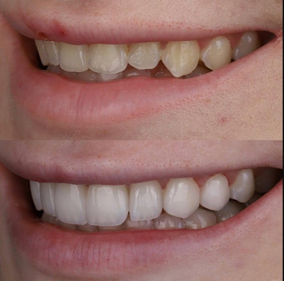 Resultados Diseño de Sonrisa de Hollywood - Caso 35