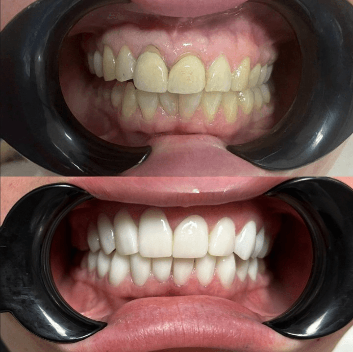 Resultados Diseño de Sonrisa de Hollywood - Caso 39