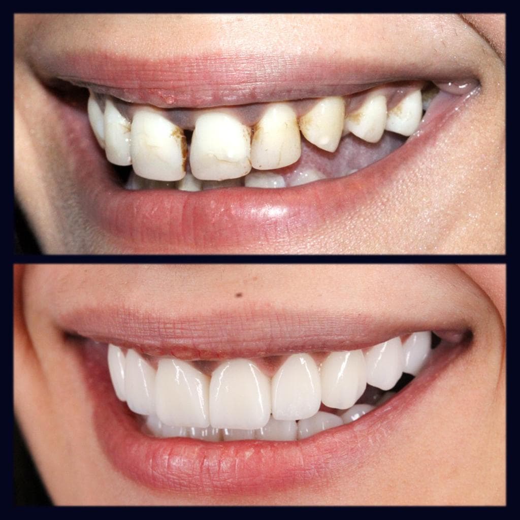 Resultados Diseño de Sonrisa de Hollywood - Caso 40