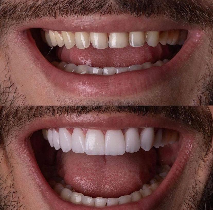 Resultados Diseño de Sonrisa de Hollywood - Caso 42
