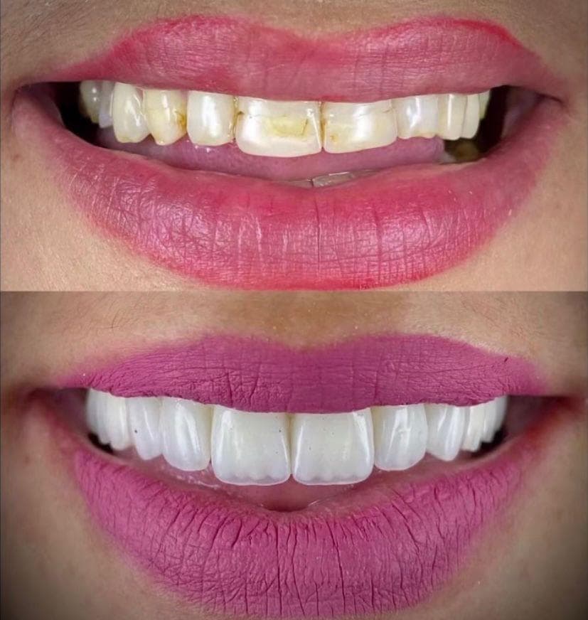 Resultados Diseño de Sonrisa de Hollywood - Caso 43