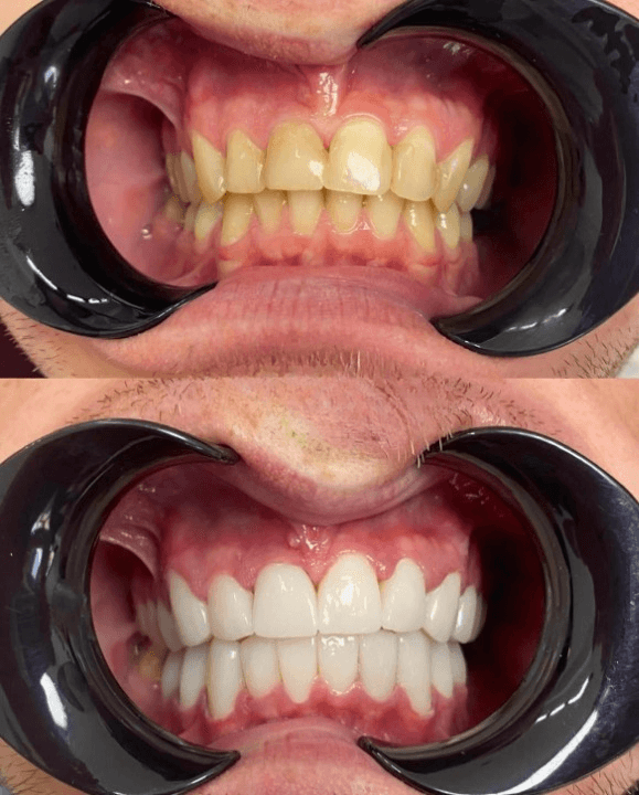 Resultados Diseño de Sonrisa de Hollywood - Caso 46