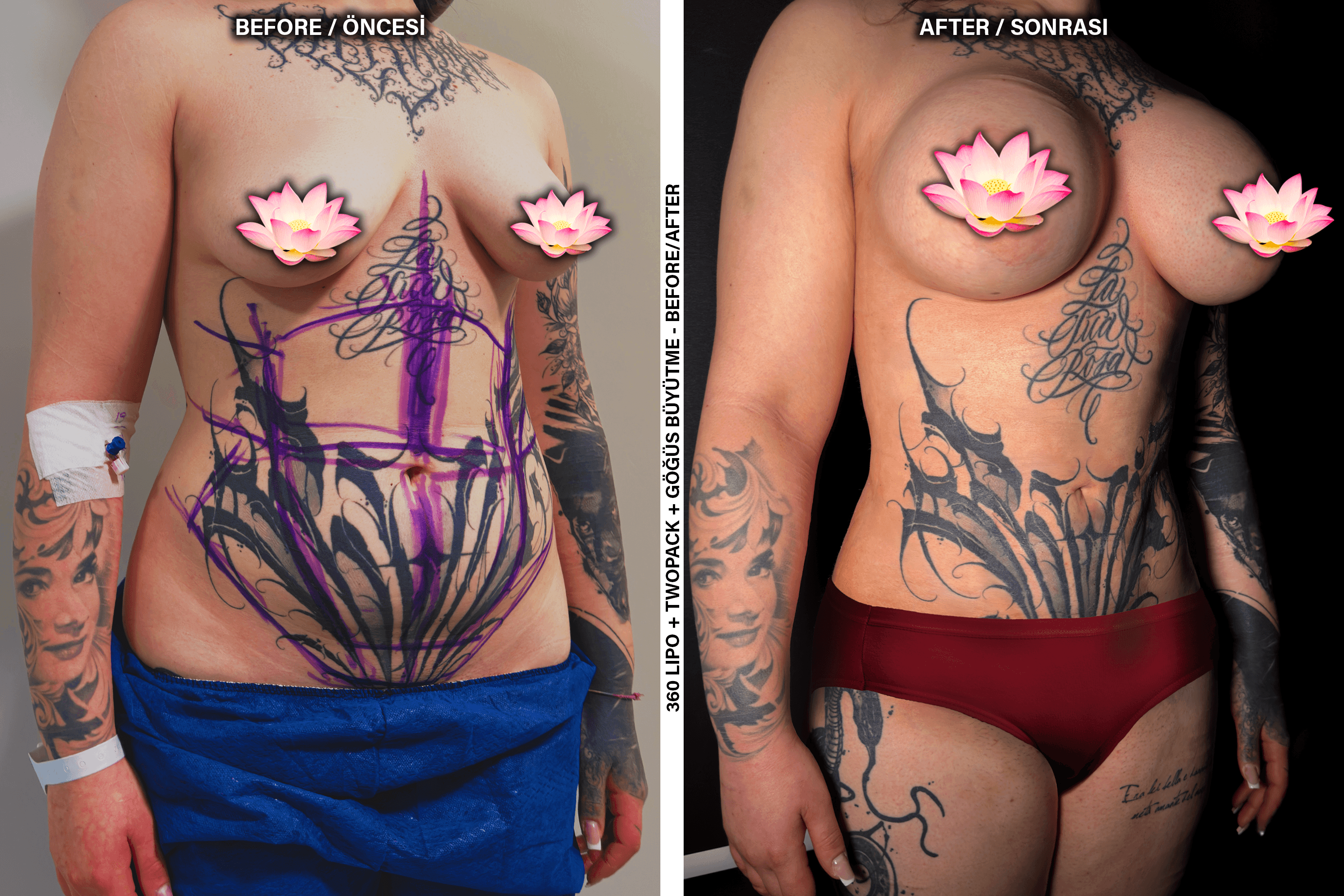Rezultate Mommy Makeover (Restaurare Post-Natală) - Cazul 2
