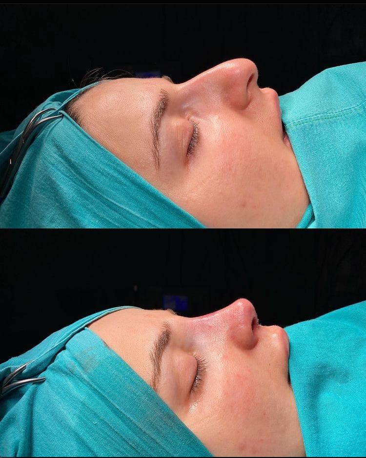 Rezultate Rinoplastie Ultrasonică Piezo - Cazul 1