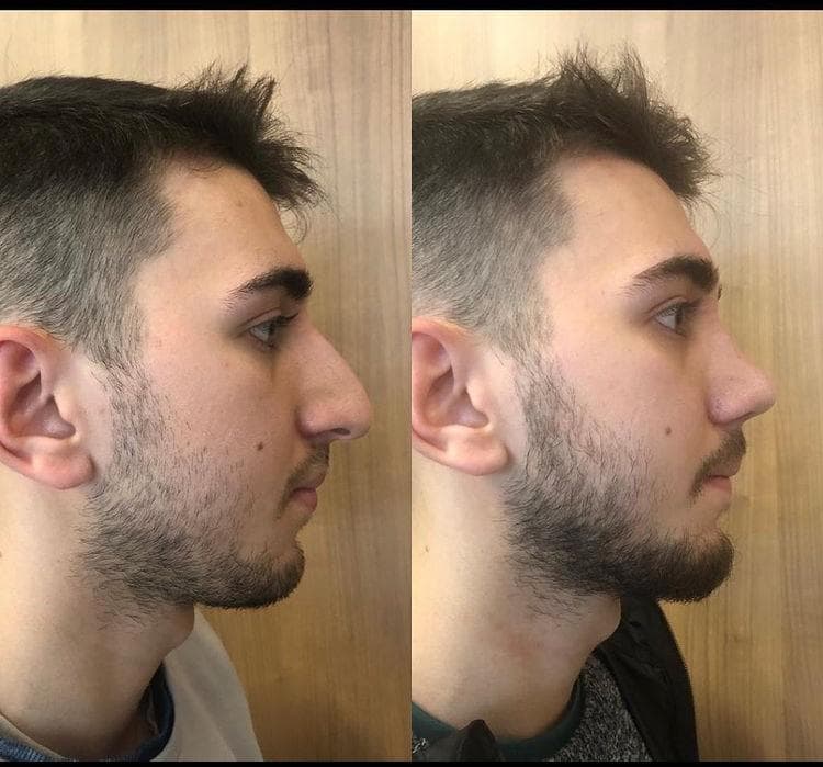 Rezultate Rinoplastie Ultrasonică Piezo - Cazul 2