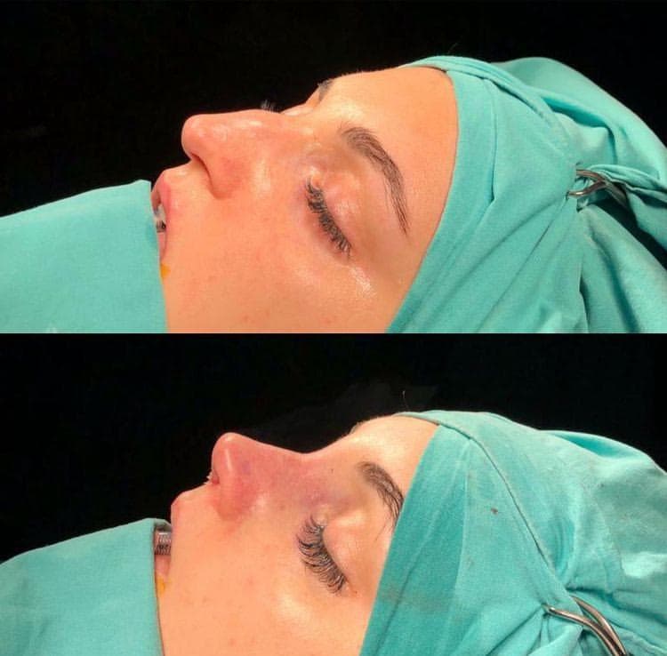 Rezultate Rinoplastie Ultrasonică Piezo - Cazul 3