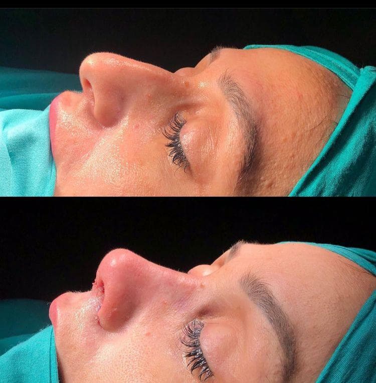 Rezultate Rinoplastie Ultrasonică Piezo - Cazul 5
