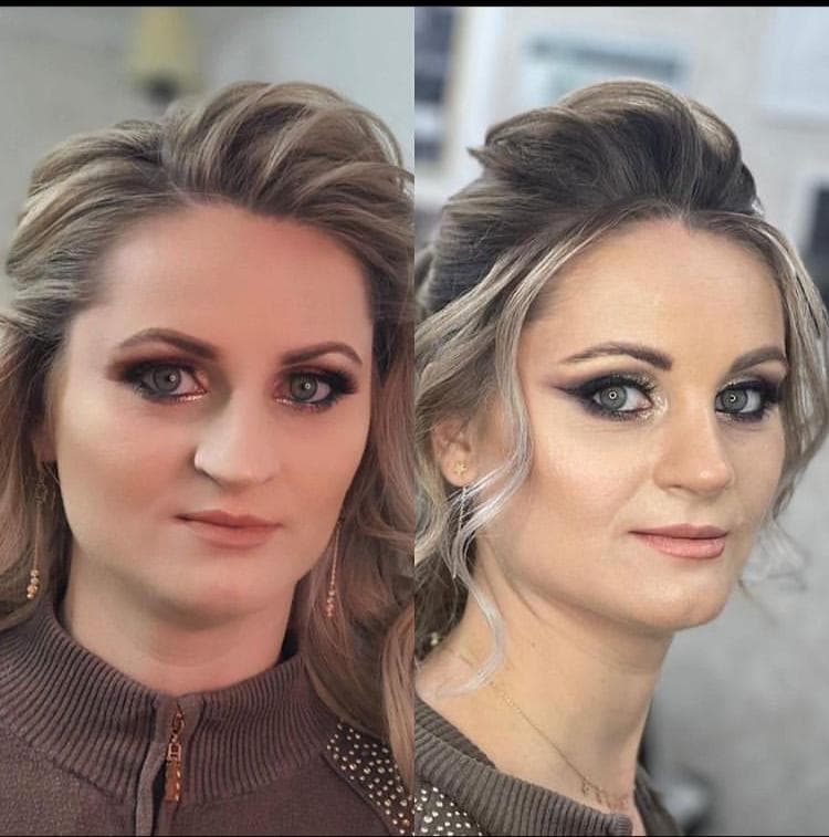 Rezultate Rinoplastie Ultrasonică Piezo - Cazul 6