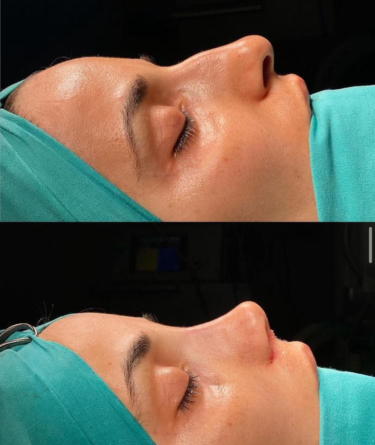 Rezultate Rinoplastie Ultrasonică Piezo - Cazul 7