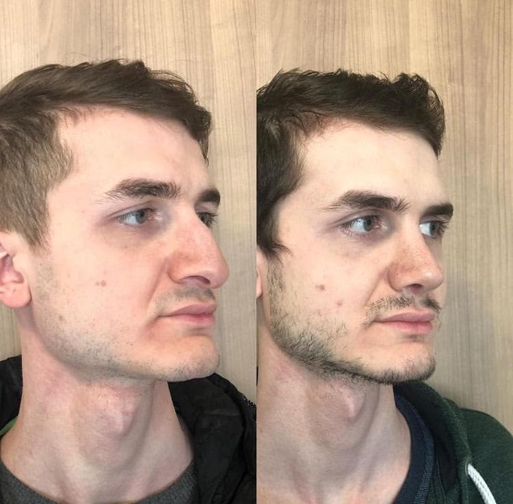 Rezultate Rinoplastie Ultrasonică Piezo - Cazul 8