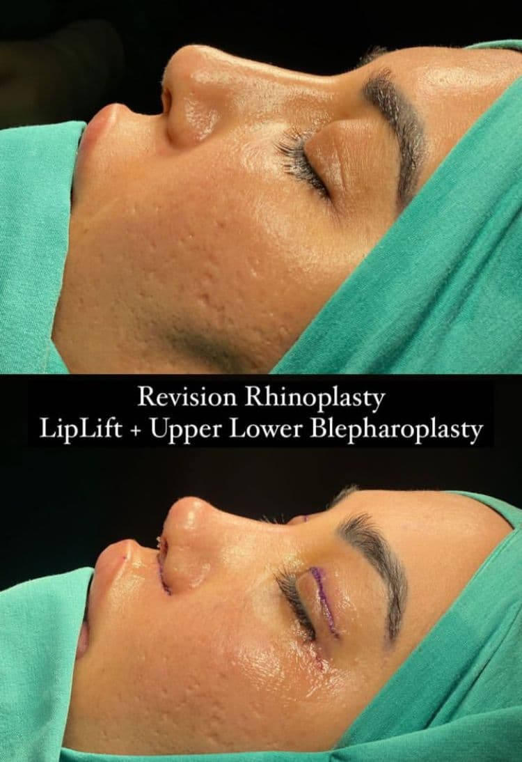 Rezultate Rinoplastie Ultrasonică Piezo - Cazul 11