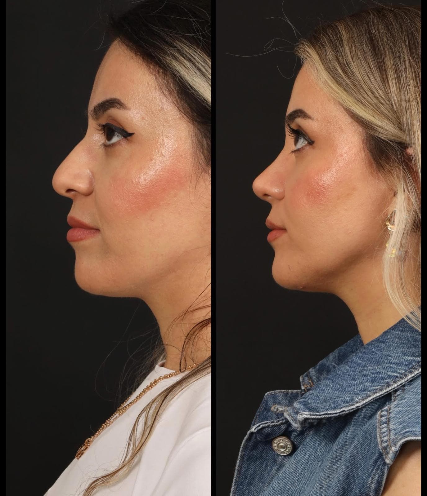 Rezultate Rinoplastie Ultrasonică Piezo - Cazul 12