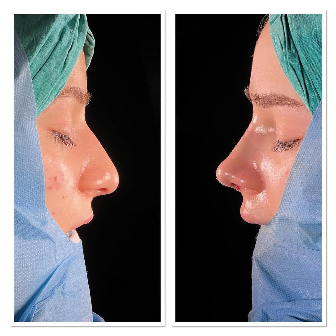 Rezultate Rinoplastie Ultrasonică Piezo - Cazul 14
