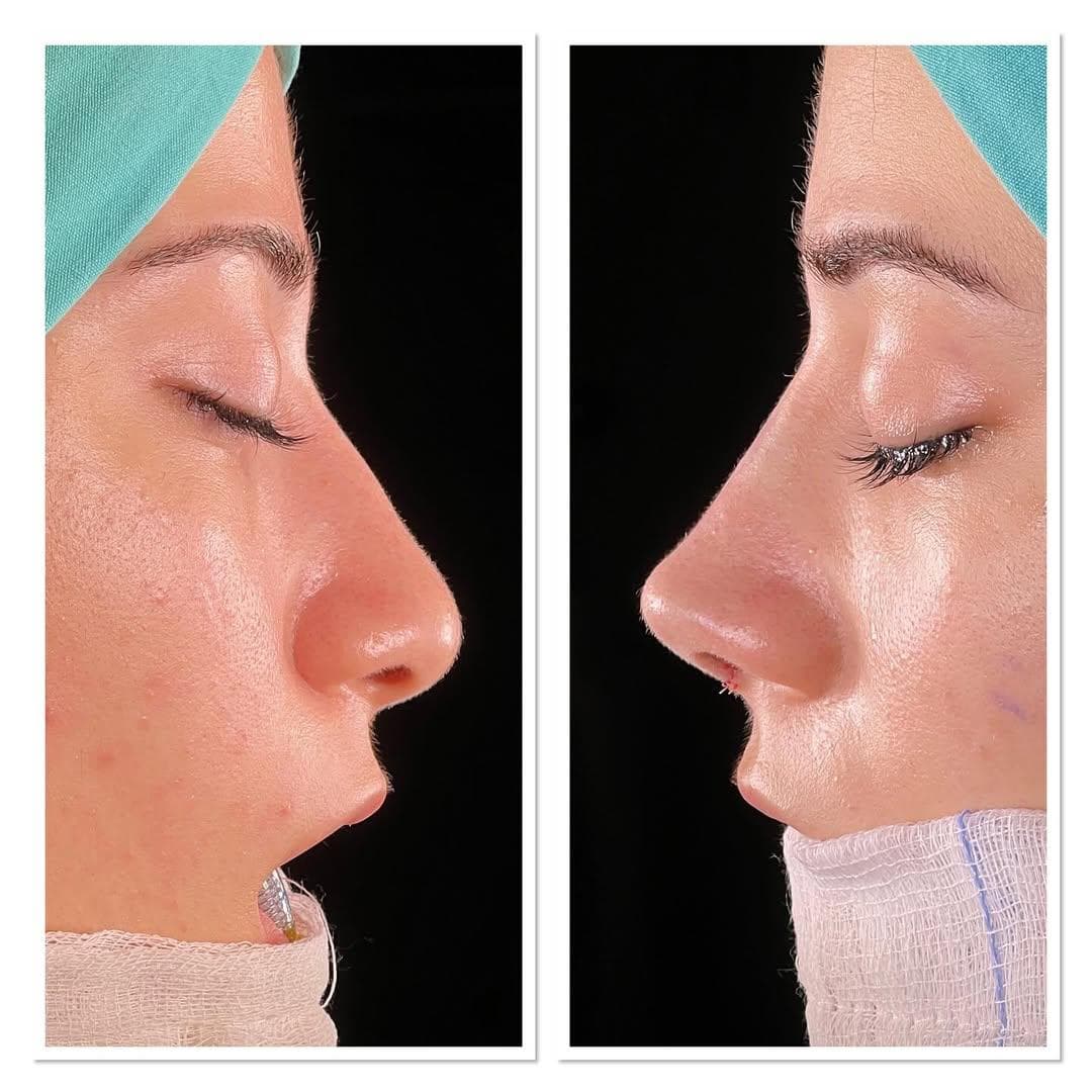 Rezultate Rinoplastie Ultrasonică Piezo - Cazul 15