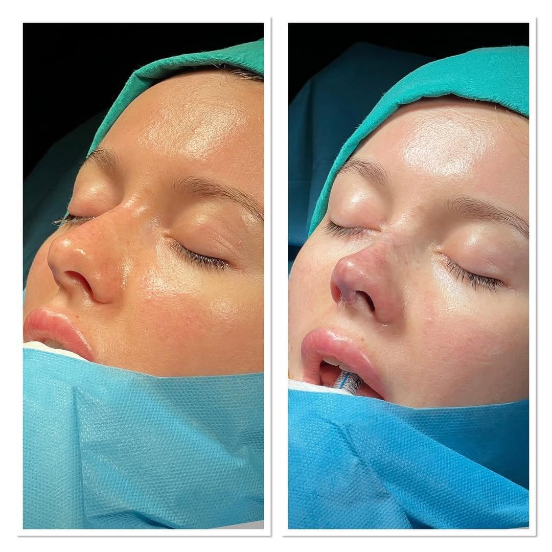 Rezultate Rinoplastie Ultrasonică Piezo - Cazul 17