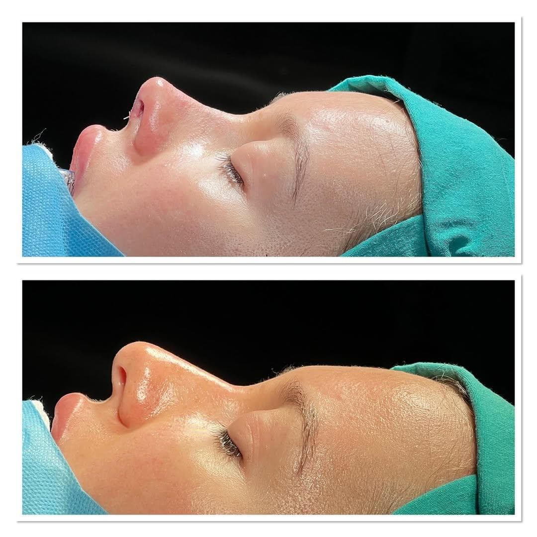 Rezultate Rinoplastie Ultrasonică Piezo - Cazul 18