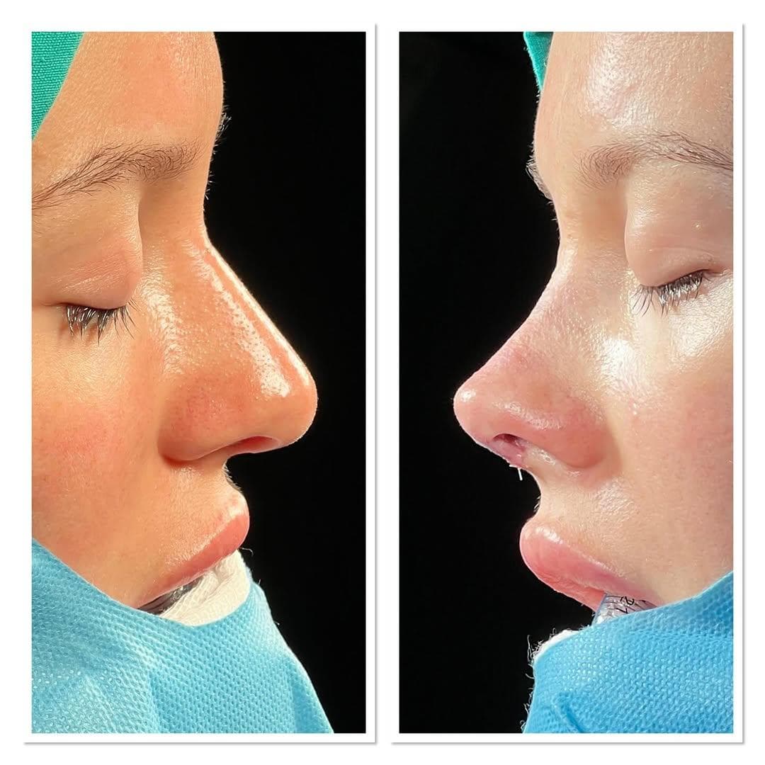 Rezultate Rinoplastie Ultrasonică Piezo - Cazul 19