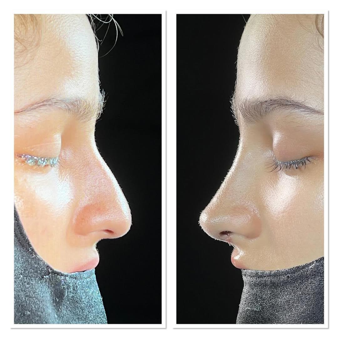 Rezultate Rinoplastie Ultrasonică Piezo - Cazul 20