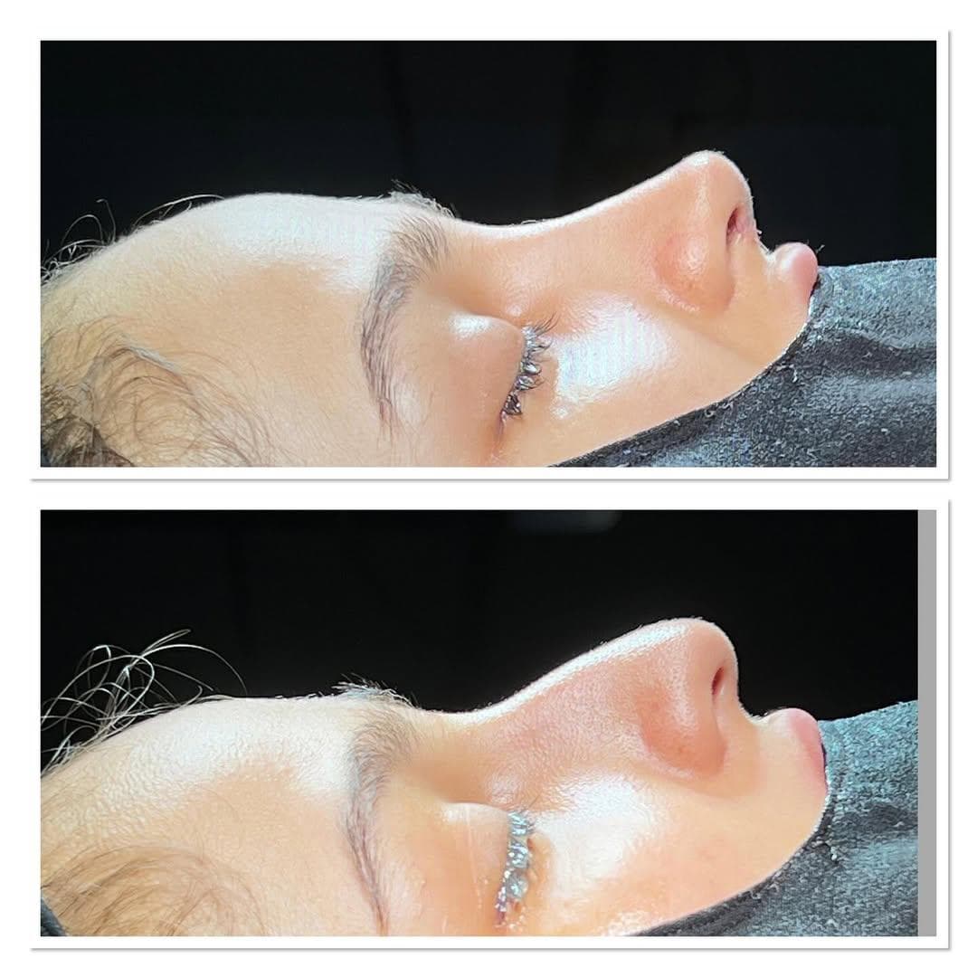 Rezultate Rinoplastie Ultrasonică Piezo - Cazul 21